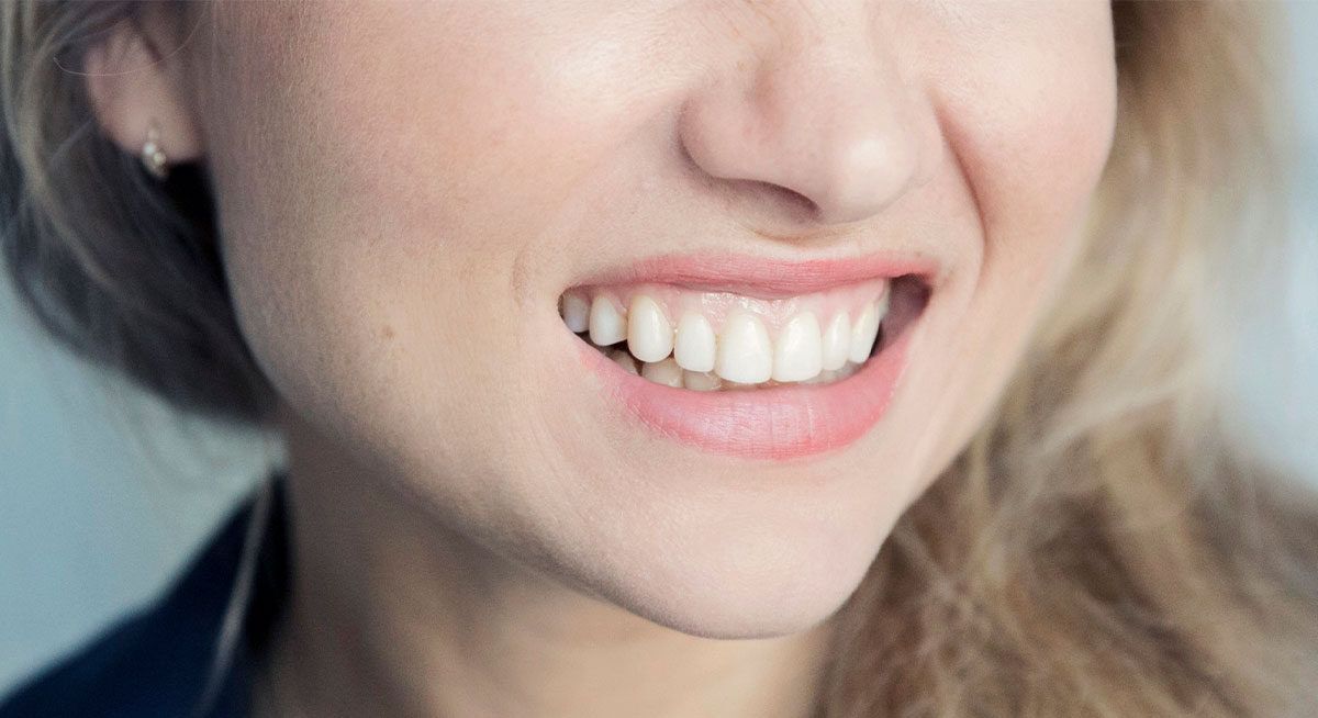 Kvinde har fået tandfacader og kan nu fremvise et flot hollywood smile