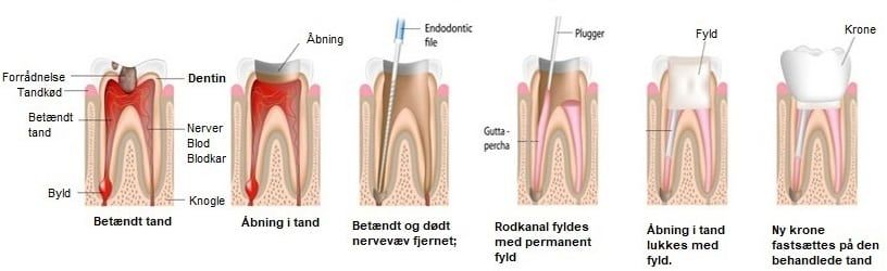 Ondt gør rodbehandlet tand Tandrodsbetændelse