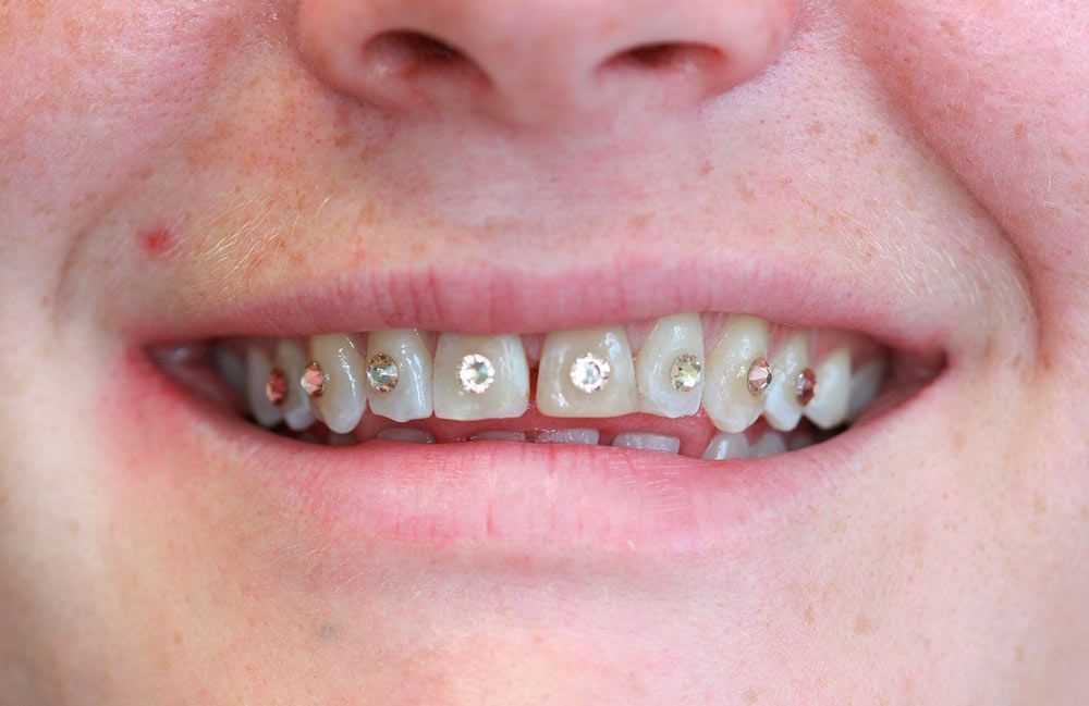 Tænder med tandsmykker