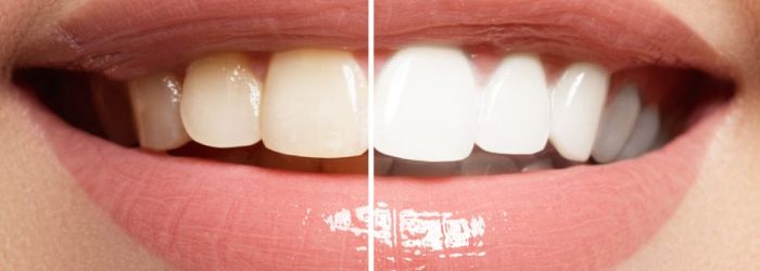 Læs mere om vores kosmetiske tandbehandling, tandblegning