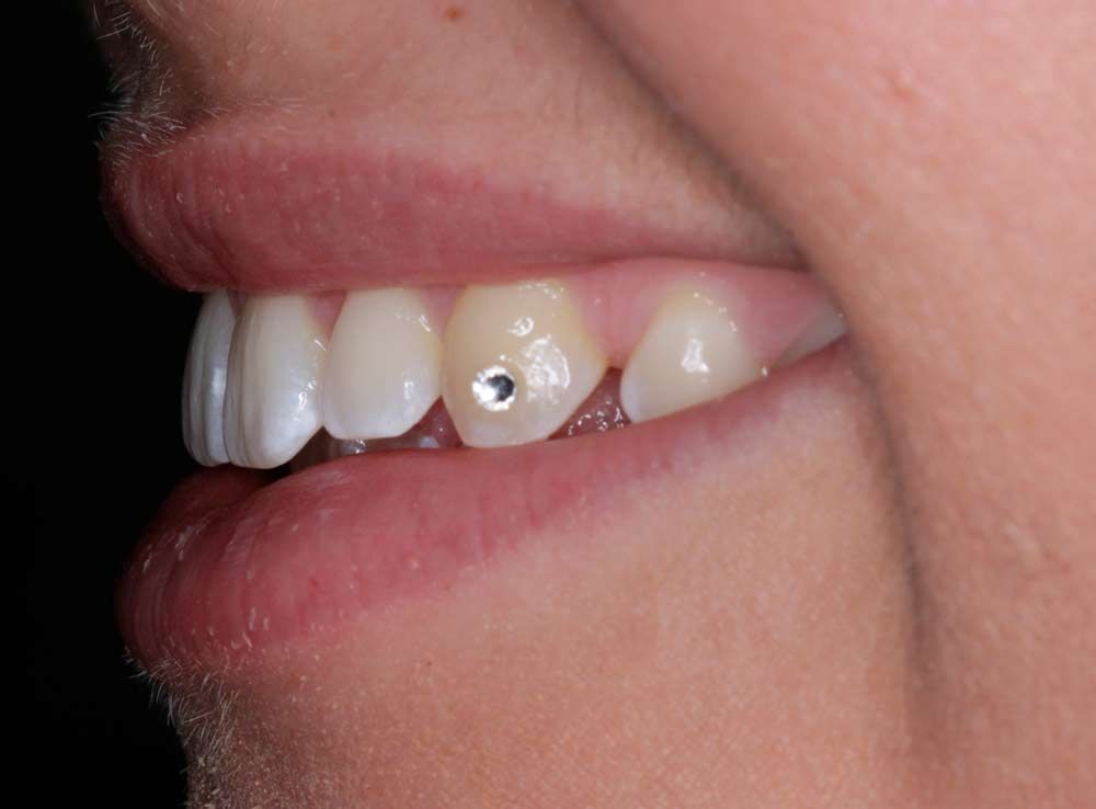 Tænder med tandsmykker